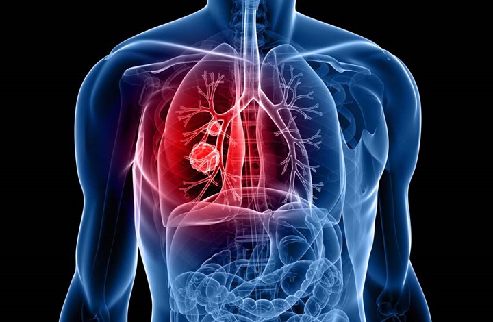 دراسة: تناول اللبن والألياف يقلل الإصابة بسرطان الرئة